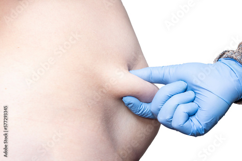 Female belly pinched by a doctor with blue rubber glove, before liposuction
