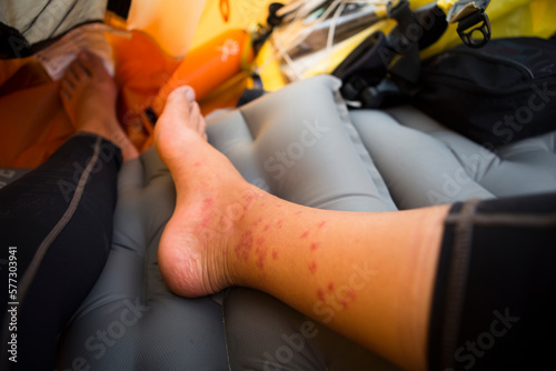 After applying steroid cream, the swelling of numerous mosquito and gnat bites are reduced to show the individual bites marks whilst resting in camp on the river banks of the Amur  photo