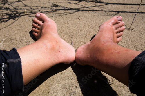 The right ankle becomes severely swollen after numerous mosquito and gnat bites on the sandy shores of the Amur river in far East Russia.
