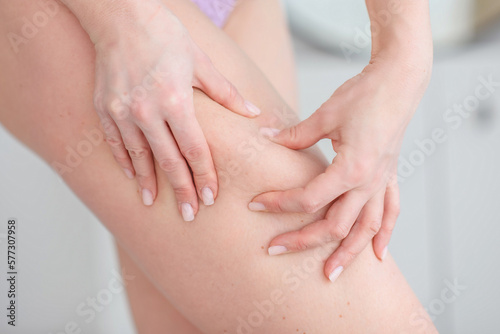 close-up of a girl showing cellulite on her thigh. Beauty and health. Anticellulite massage