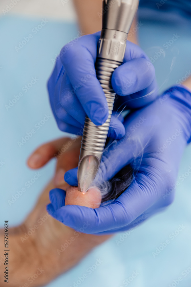 The doctor removes moles and warts with a laser beam. Mole removal