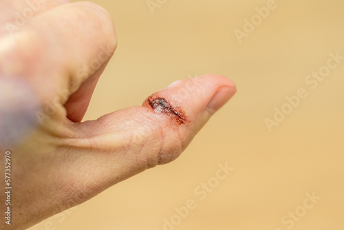 Closeup of accidental knife cut on the skin of a finger. Bleeding blood from injured finger