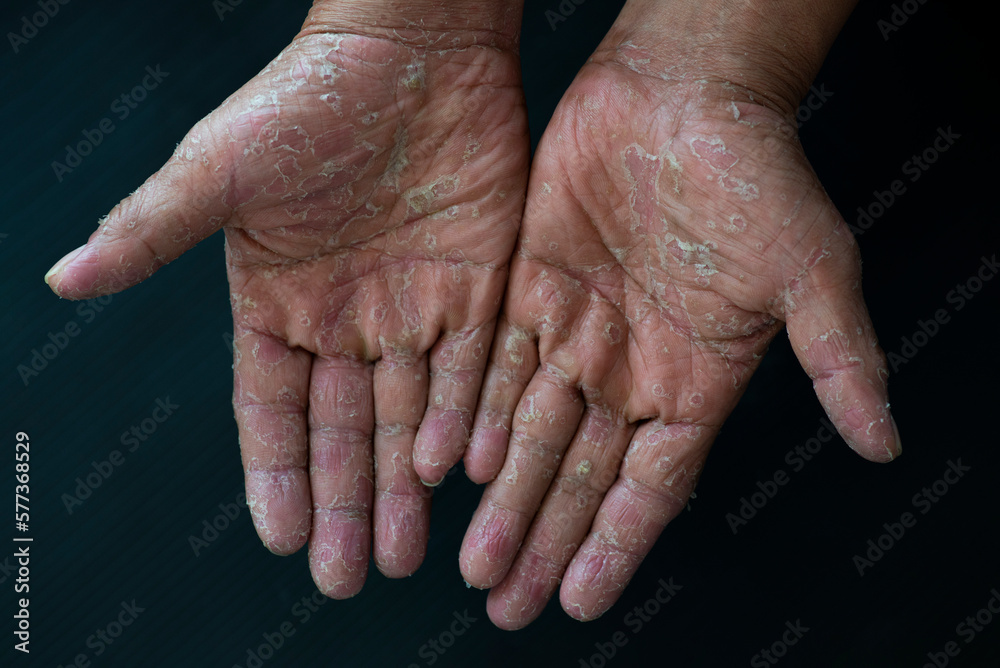 Fototapeta premium Chemical dermatitis and severe allergic reactions. There is peeling skin on the palms and feet.