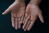 Chemical dermatitis and severe allergic reactions. There is peeling skin on the palms and feet.