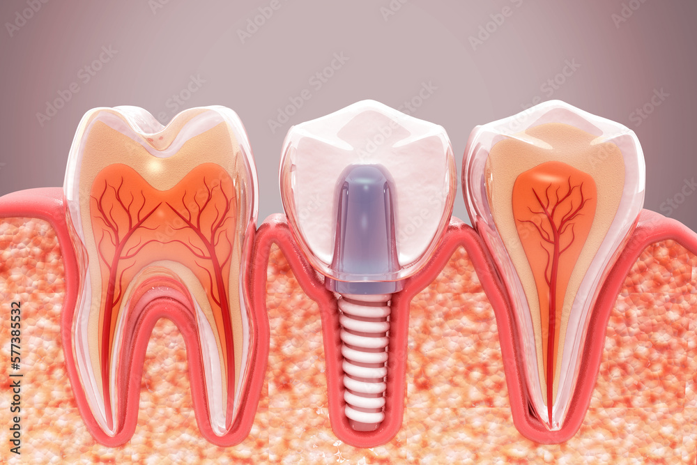 Dental implantation, jaw bones and healthy roots, implant screw and