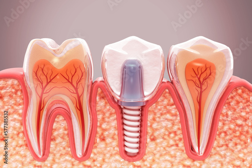 Dental implantation, jaw bones and healthy roots, implant screw and abutment, dentist and orthodontist treatment, 3d illustration photo