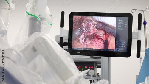 4K Real robotic prostate surgery. Close-up robotic moves on human abdomen. Medical operation involving robot. Minimally invasive robotic prostatectomy. Doctor and nurse performing procedure with robot