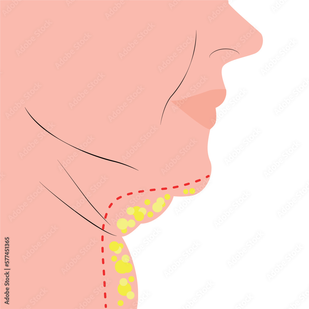 Fat double chin facelift concept Fat double chin facelift concept