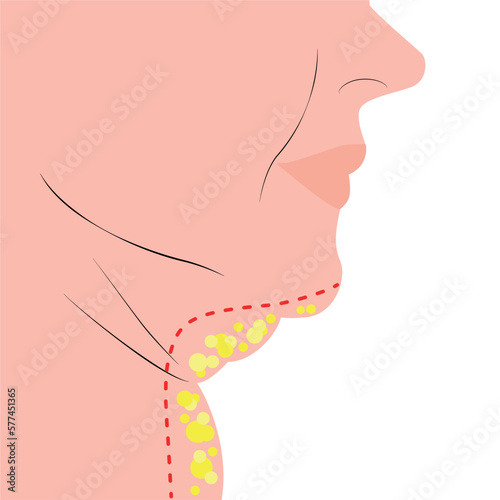 Fat double chin facelift concept