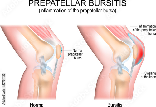 Prepatellar bursitis. inflammation of the prepatellar bursa. comparison of a human knee with Normal prepatellar bursa, and joint with Bursitis. vector poster