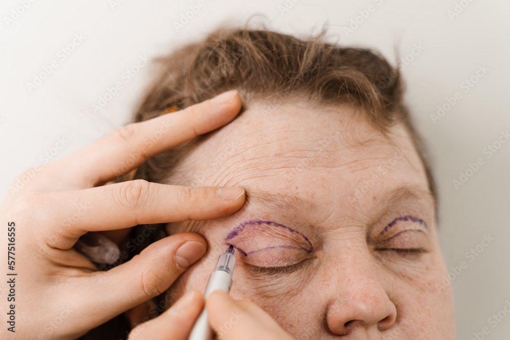 Obraz premium Blepharoplasty markup close-up on the face before the plastic surgery operation for modifying the eye region of the face in medical clinic.