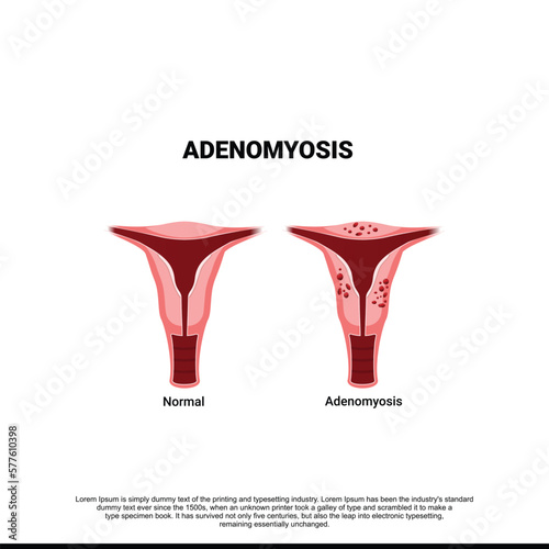 Adenomyosis. Comparison normal and unhealthy abnormal women uterus. female reproductive system. medical condition when cells endometrium atypically located among the cells of the cells of the uterine