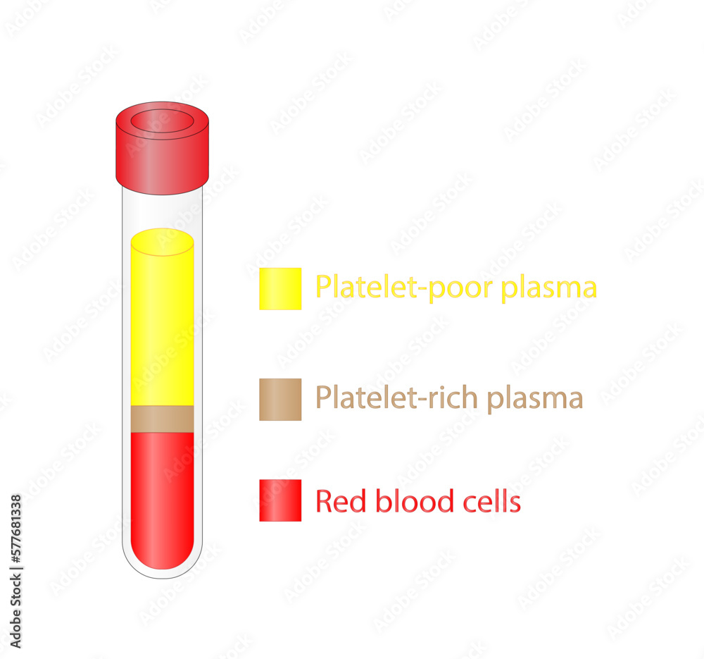 Platelet-rich plasma (prp). Autologous conditioned plasma, is a concentrate of platelet-rich plasma extracted from whole blood. After centrifugation, Extract PRP and Inject. Vector Illustration Platelet-rich plasma (prp). Autologous conditioned plasma, is a concentrate of platelet-rich plasma extracted from whole blood. After centrifugation, Extract PRP and Inject. Vector Illustration