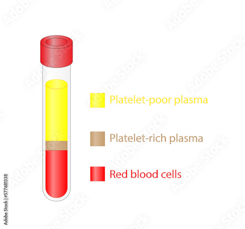 Platelet-rich plasma (prp). Autologous conditioned plasma, is a concentrate of platelet-rich plasma extracted from whole blood. After centrifugation, Extract PRP and Inject. Vector Illustration