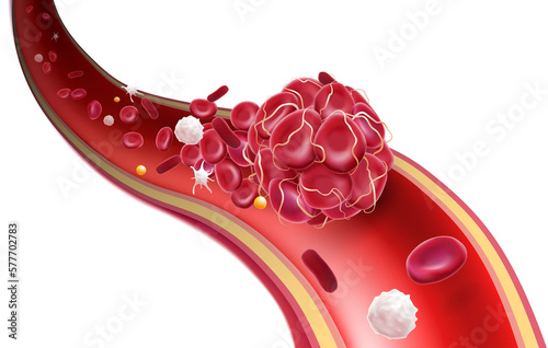 3D illustration of a blood clot in a blood vessel showing a blocked blood flow with platelets and white blood cells in the image. medical use education and science photo