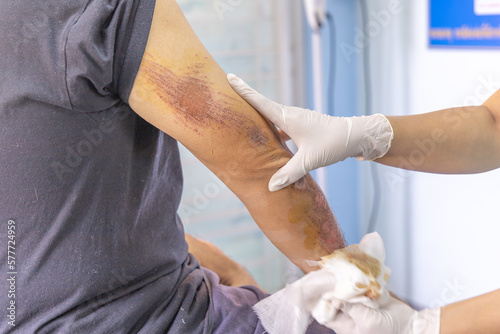 abrasion wound man photo