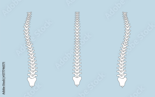 human spine in normal and with scoliosis photo