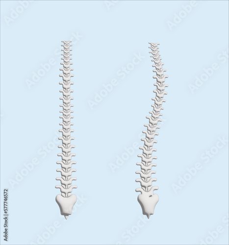 human spine in normal and with scoliosis