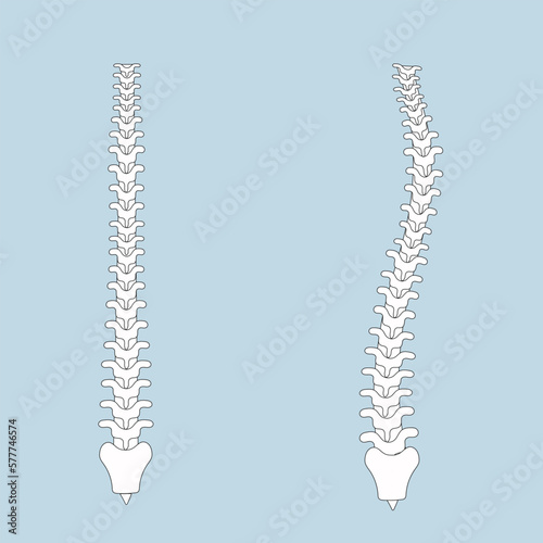 human spine in normal and with scoliosis