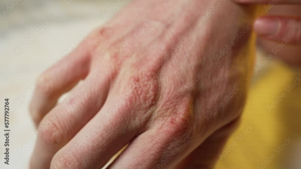 Male hand with dry cracked skin close up Male hand with dry cracked skin close up