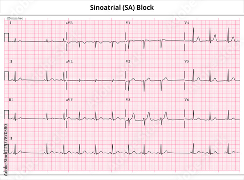 Sinoatrial (SA) Block - ECG Paper 12 Lead - Electrocardiogram - Vector Medical Illustration