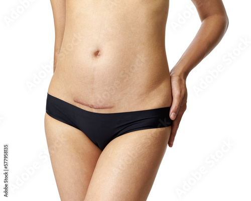 Closeup of woman belly with a scar from a cesarean section with her hands on white background photo