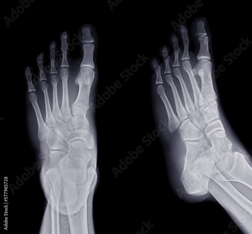 Foot x-ray image AP and Oblique  view  isolated on black background. © samunella