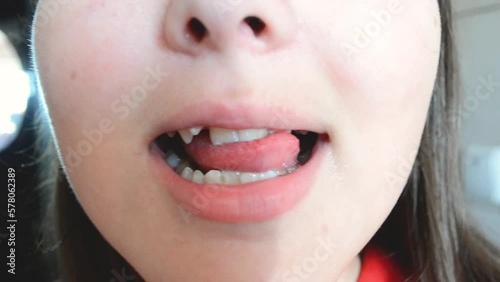 Close-up portrait of female smiling mouth with teeth, dental portrait of teeth,tooth deformity pathology