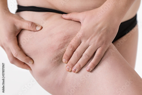 Female hands squeezing her thigh to show cellulite closeup. Woman shows holding and pushing skin of hips cellulite, orange peel. Treatment and disposal of excess weight, deposition of subcutaneous fat