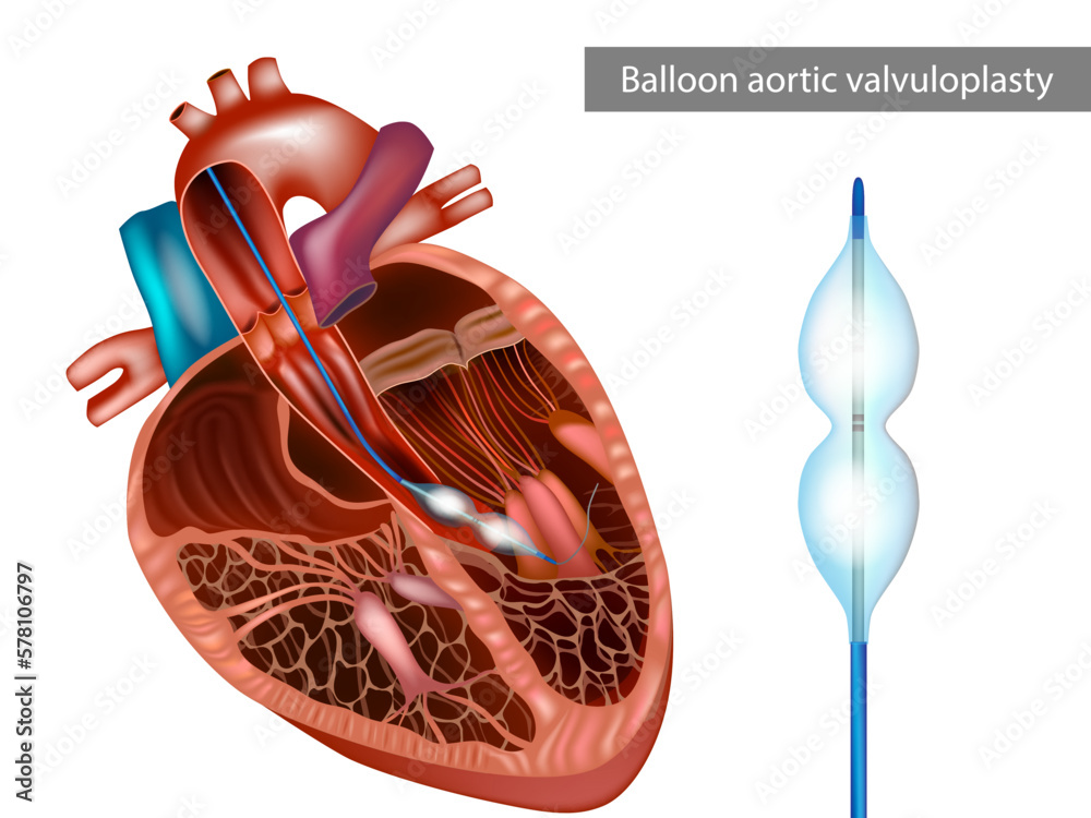 Vecteur Stock Balloon aortic valvuloplasty or BAV. The balloon catheter is  advanced. Increase aortic valve area and systemic blood flow. Aortic  stenosis, or narrowing of the aortic valve. | Adobe Stock
