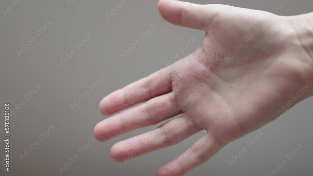 atopic dermatitis on hands dry itchy inflamed skin flare irritations on