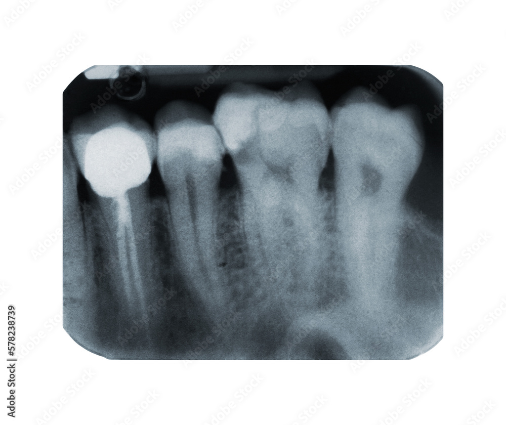 Real xray of devitalized tooth. Xray of root canal treatment tooth