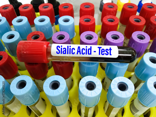 Blood sample tube for Sialic acid testing in medical laboratory photo