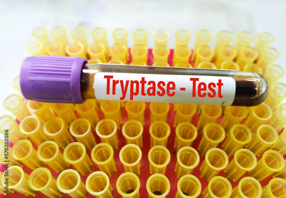 blood-sample-tube-for-mast-cell-tryptase-test-a-tryptase-test-can-help