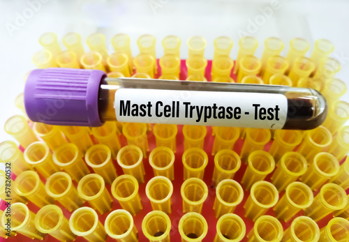 Blood sample tube for Mast cell Tryptase test. A Tryptase test can help doctors determine if a severe allergic reaction (ANAPHYLAXIS) has occurred photo