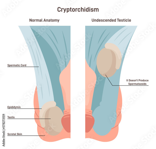 Cryptorchidism. Absence of one or both testes from the scrotum.