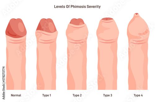 Types of phimosis. Inability to retract the foreskin covering the head