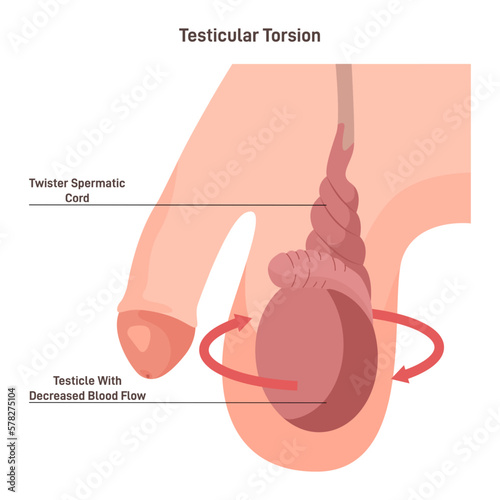 Testicular torsion. Testicle rotation, twisting the spermatic cord and blood
