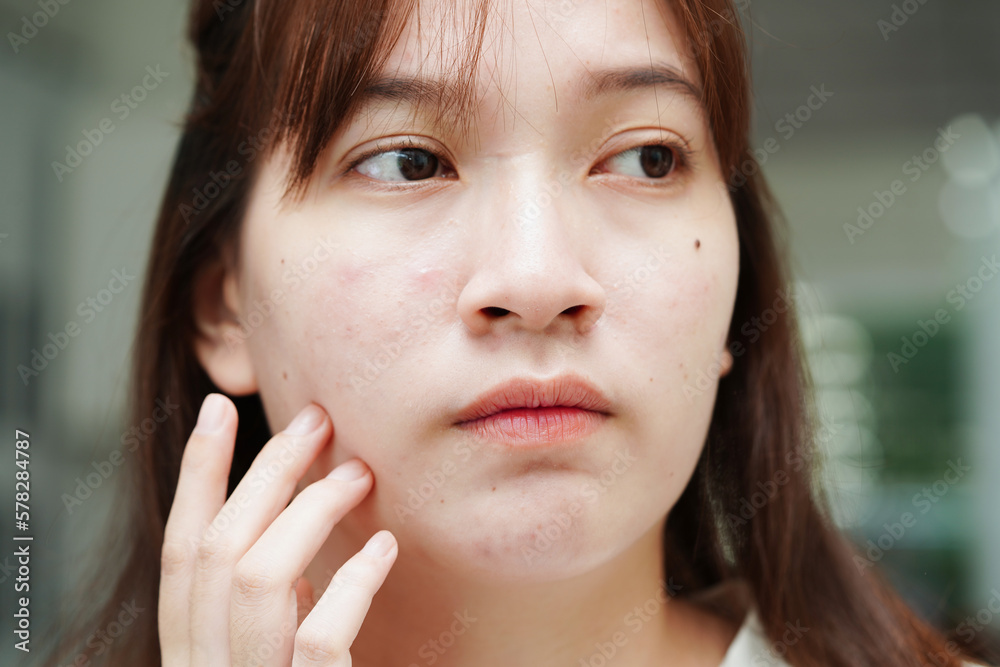 Acne pimple and scar on skin face, disorders of sebaceous glands, teenage girl skincare beauty problem. Acne pimple and scar on skin face, disorders of sebaceous glands, teenage girl skincare beauty problem.