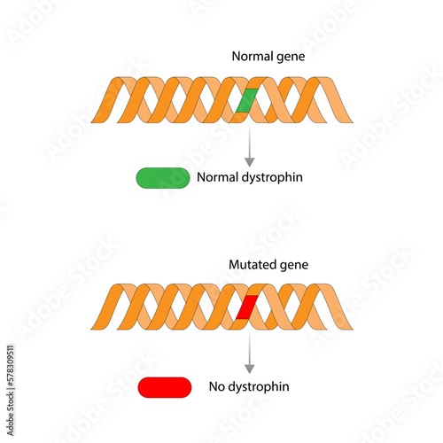 Muscular dystrophy ,MD, Duchenne MD syndrome, mutations in genes responsible for healthy muscle structure and function. Vector illustration. photo