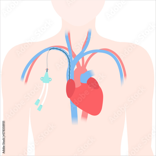 Tunneled central venous catheter placed in the subclavian vein. Patient with CVC long term access device for chemotherapy infusions and blood sampling. Central line tube close up. Vector illustration.