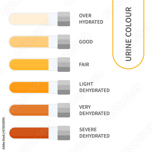 Urine colour chart. Hydration and dehydration level diagram. Medical urinal test kit for urinary tract infection research. Containers with yellow to brown pee for urinalysis. Vector illustration.
