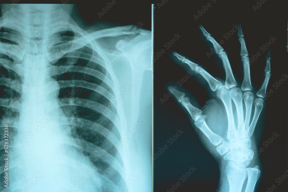 The xray plates of the ribs and hands of a patient. Conventional xray
