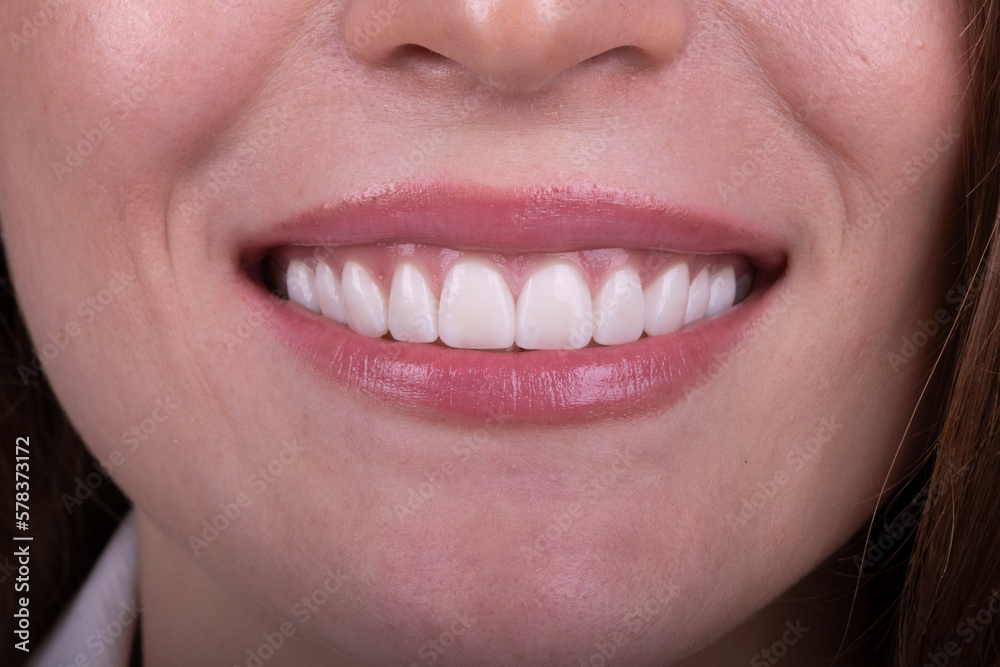 Dental Veneers: Enhance Your Smile with Cosmetic Dentistry. Dental Veneers: Enhance Your Smile with Cosmetic Dentistry.