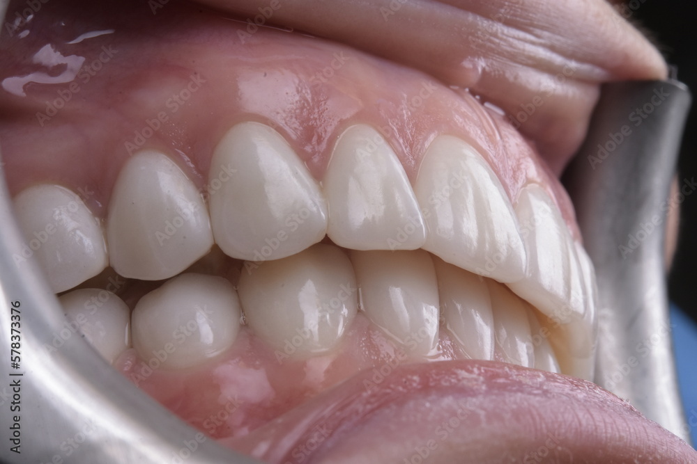 Dental Veneers: Enhance Your Smile with Cosmetic Dentistry.