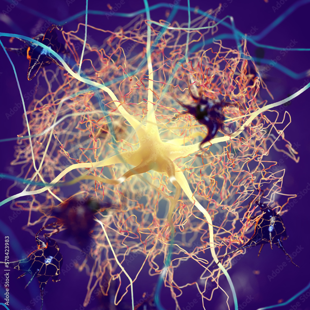 Amyloid plaques forming between neurons. Betaamyloid protein