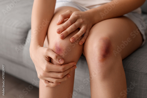 Young woman with bruised legs sitting on sofa at home  closeup
