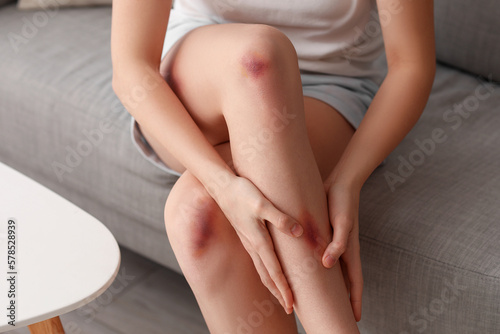 Young woman with bruised legs sitting on sofa at home, closeup