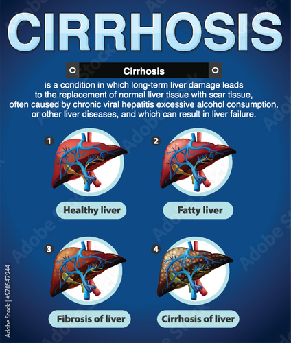 Stages of Liver Damage Infographic photo