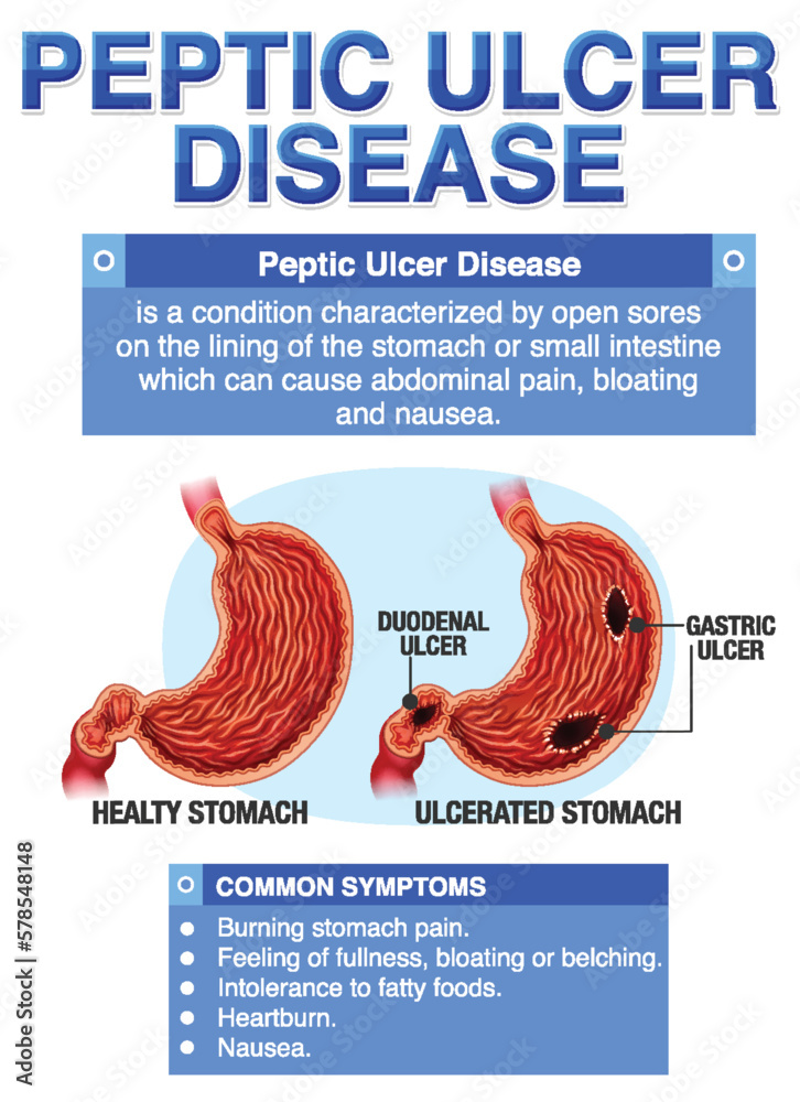 Peptic Ulcer Disease Explained Infographic Stock Vector | Adobe Stock